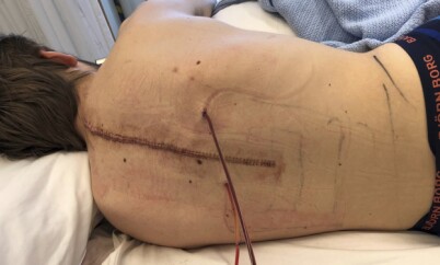 OPERERT: En svulst i ryggraden ga Marcus sterke hode- og nakkesmerter. Senere dukket en ny og enda hissigere svulst opp. Foto: Privat OPERERT: En svulst i ryggraden ga Marcus sterke hode- og nakkesmerter. Senere dukket en ny og enda hissigere svulst opp. Foto: Privat